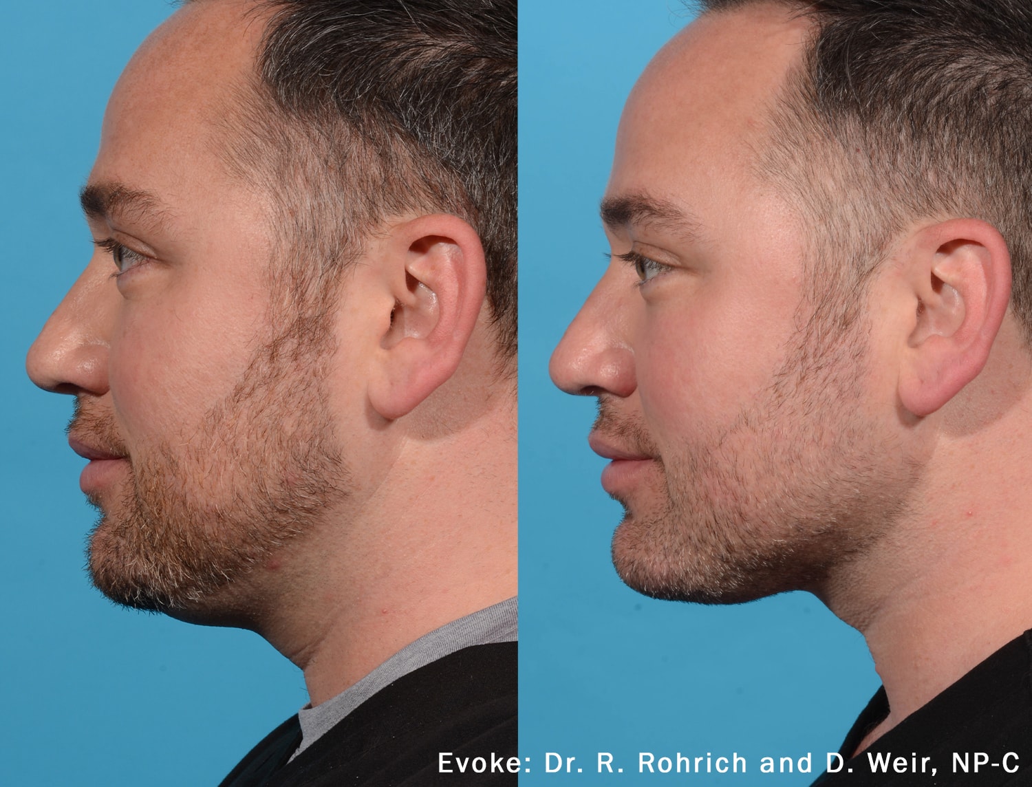 Before and After photos of Evoke treatments reducing fat and contouring a man’s neck, chin and jawline