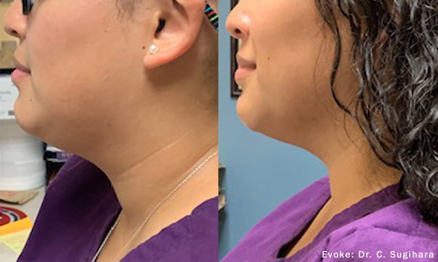 Before and After photos of Dr. Sugihara’s Evoke treatments reducing fat and contouring a woman’s neck and chin