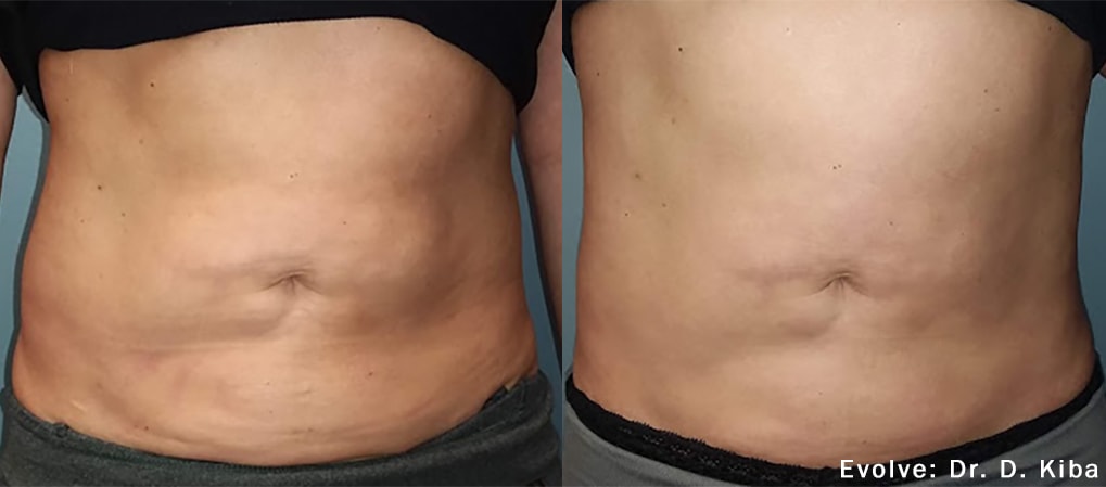 Before and After photos of Evolve X treatments reducing fat and tightening loose skin on a woman’s abdomen