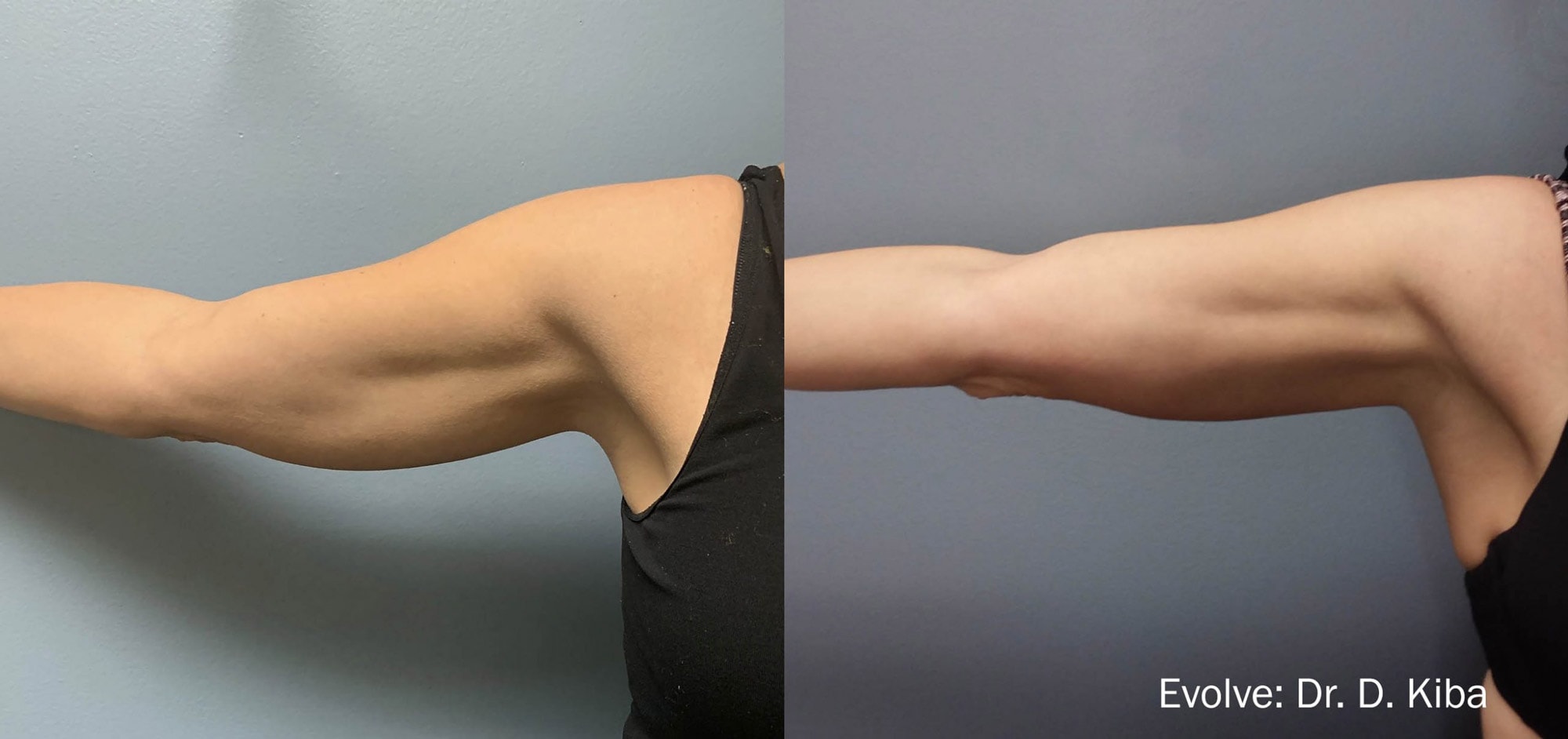 Before and After photos of Evolve X treatments reducing fat, tightening skin and contouring a woman’s arms