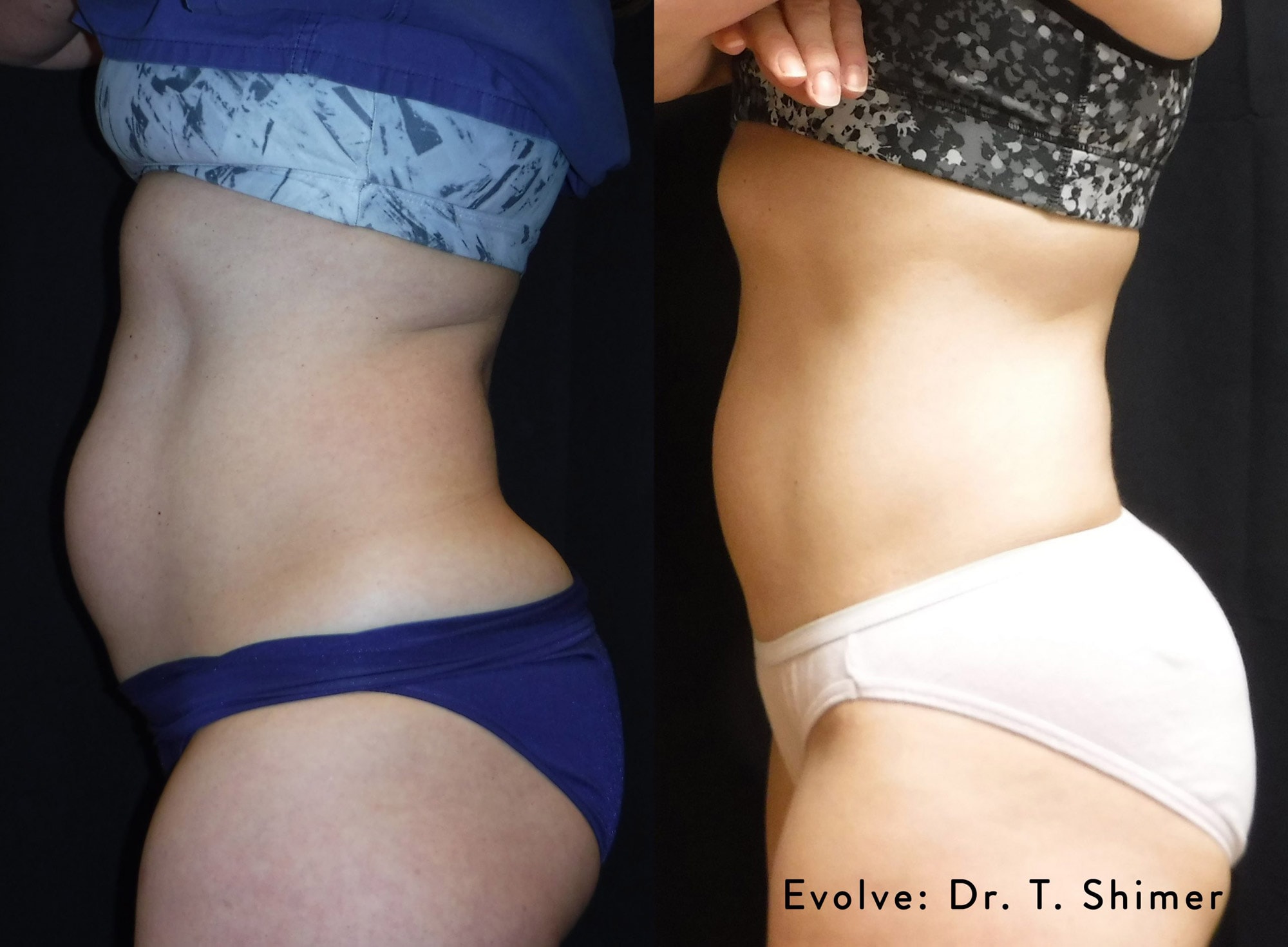 Before and After photos of Evolve X treatments reducing fat and contouring a woman’s abdomen and butt