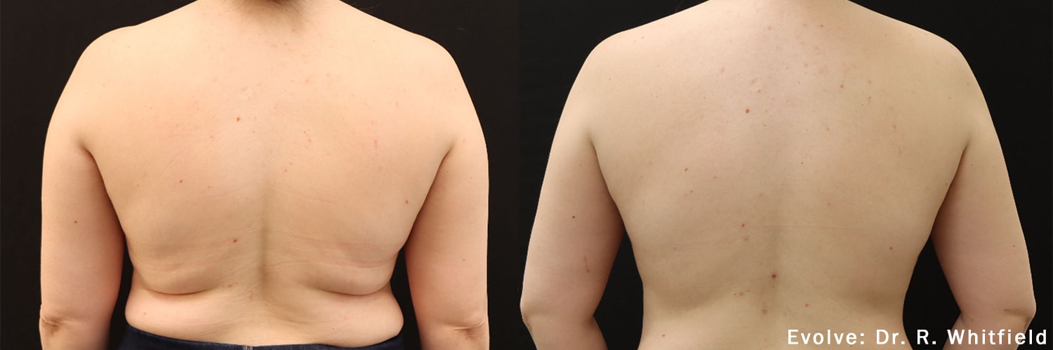 Before and After photos of Evolve X treatments reducing fat and contouring a woman’s back, waist and flanks