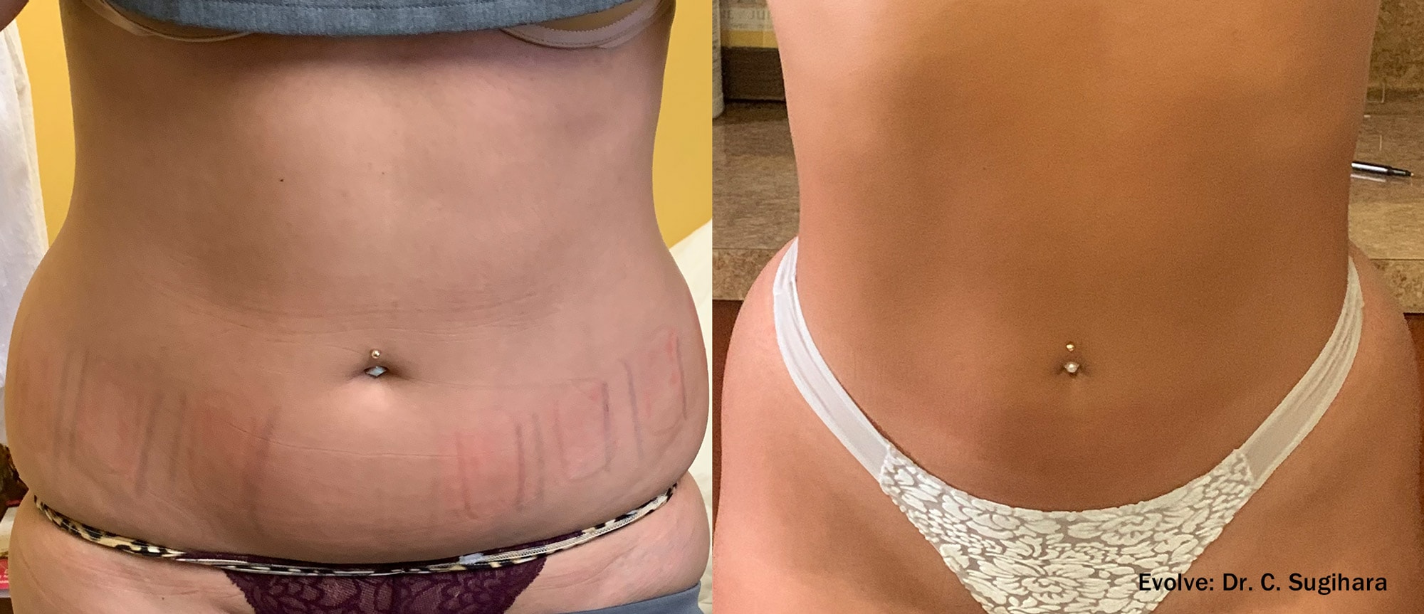 Before and After photos of Dr. Sugihara’s Evolve X treatments reducing fat and contouring a woman’s hips and waist
