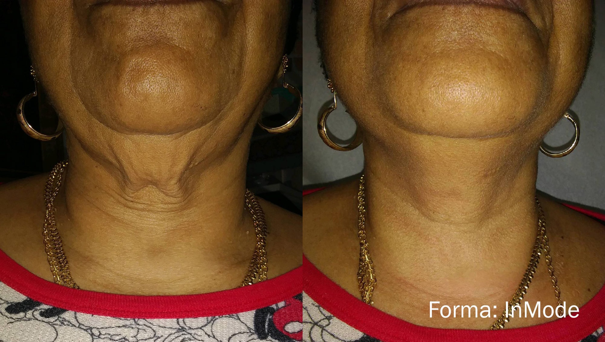 Before and After photos of Forma treatments tightening wrinkles and loose skin on a woman’s neck and chin