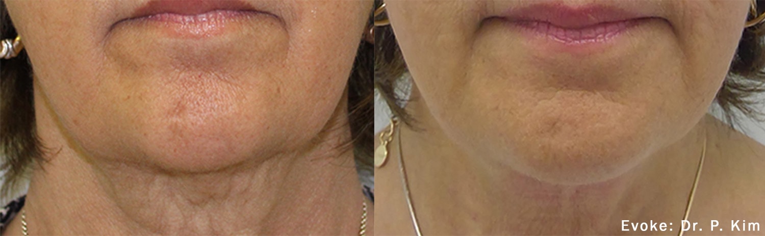Before and After photos of Evoke treatments tightening wrinkles and loose neck skin while improving woman’s chin contour