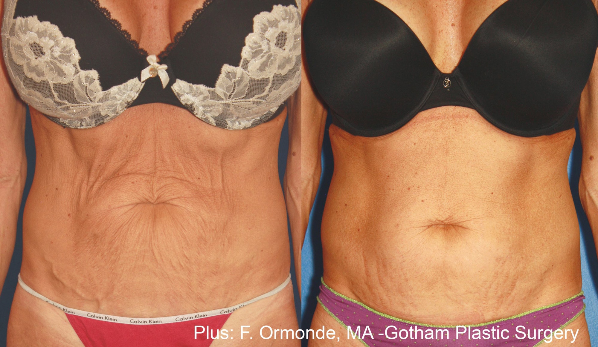 Before and After photos of Forma Plus treatments tightening loose skin and reducing wrinkles on a woman’s abdomen