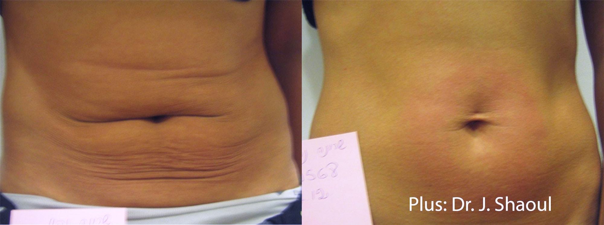 Before and After photos of Forma Plus treatments tightening loose skin and eliminating wrinkles on a woman’s abdomen