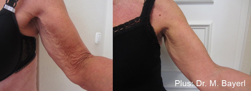 Before and After photos of Forma Plus treatments tightening loose skin and eliminating wrinkles on a woman’s arms