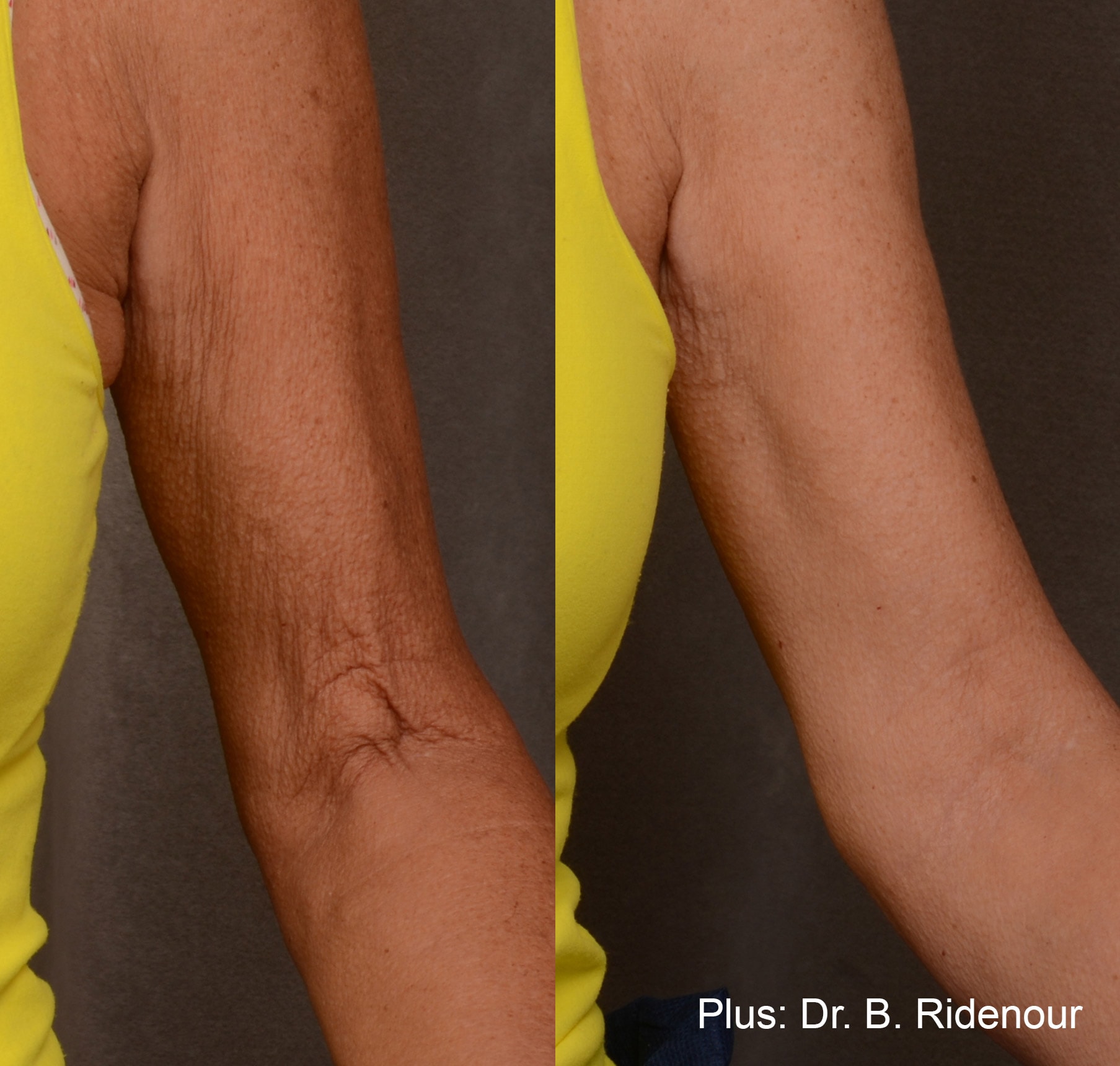 Before and After photos of Forma Plus treatments removing wrinkles and tightening loose skin on a woman’s arms