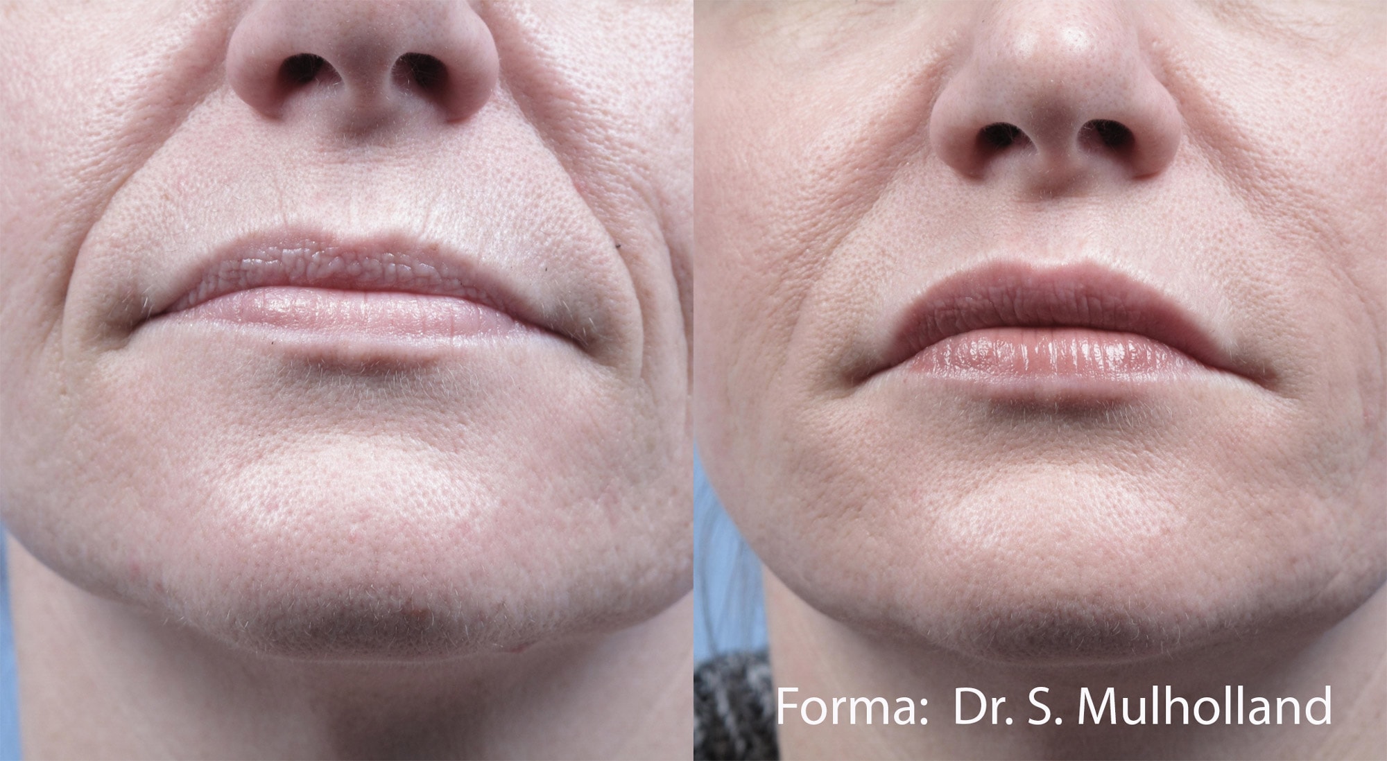 Before and After photos showing Forma treatments helping to remove fine lines and wrinkles around a woman’s mouth