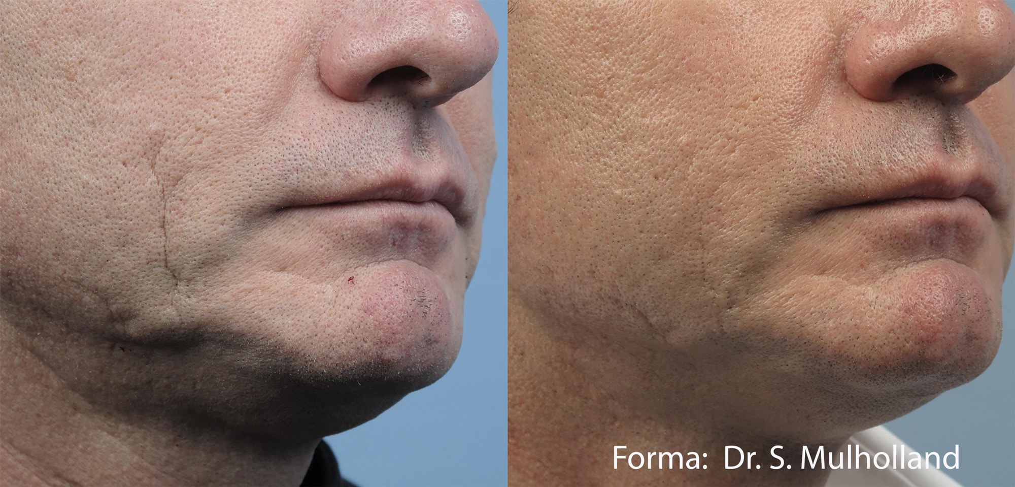 Before and After photos of Forma treatments improving the jawline and reducing the prominence of scars on a man’s face