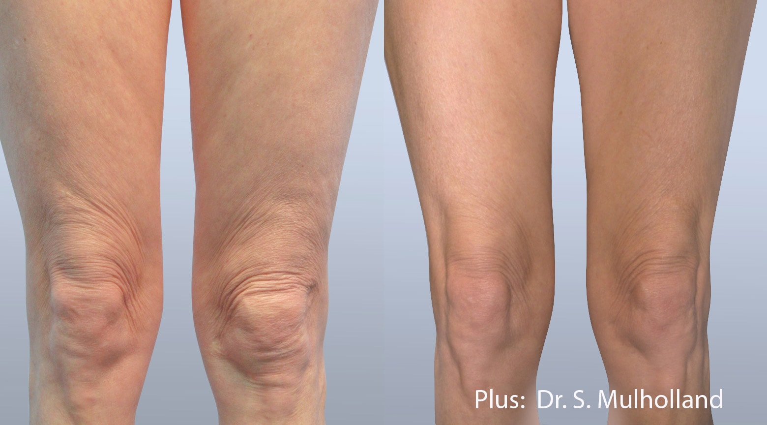 Before and After photos of Forma Plus treatments tightening loose skin and eliminating wrinkles around a woman’s knees