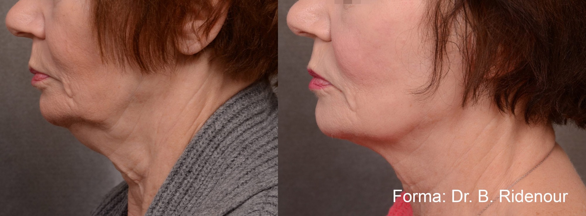 Before and After photos of Forma treatments tightening loose skin and contouring a woman’s neck and chin