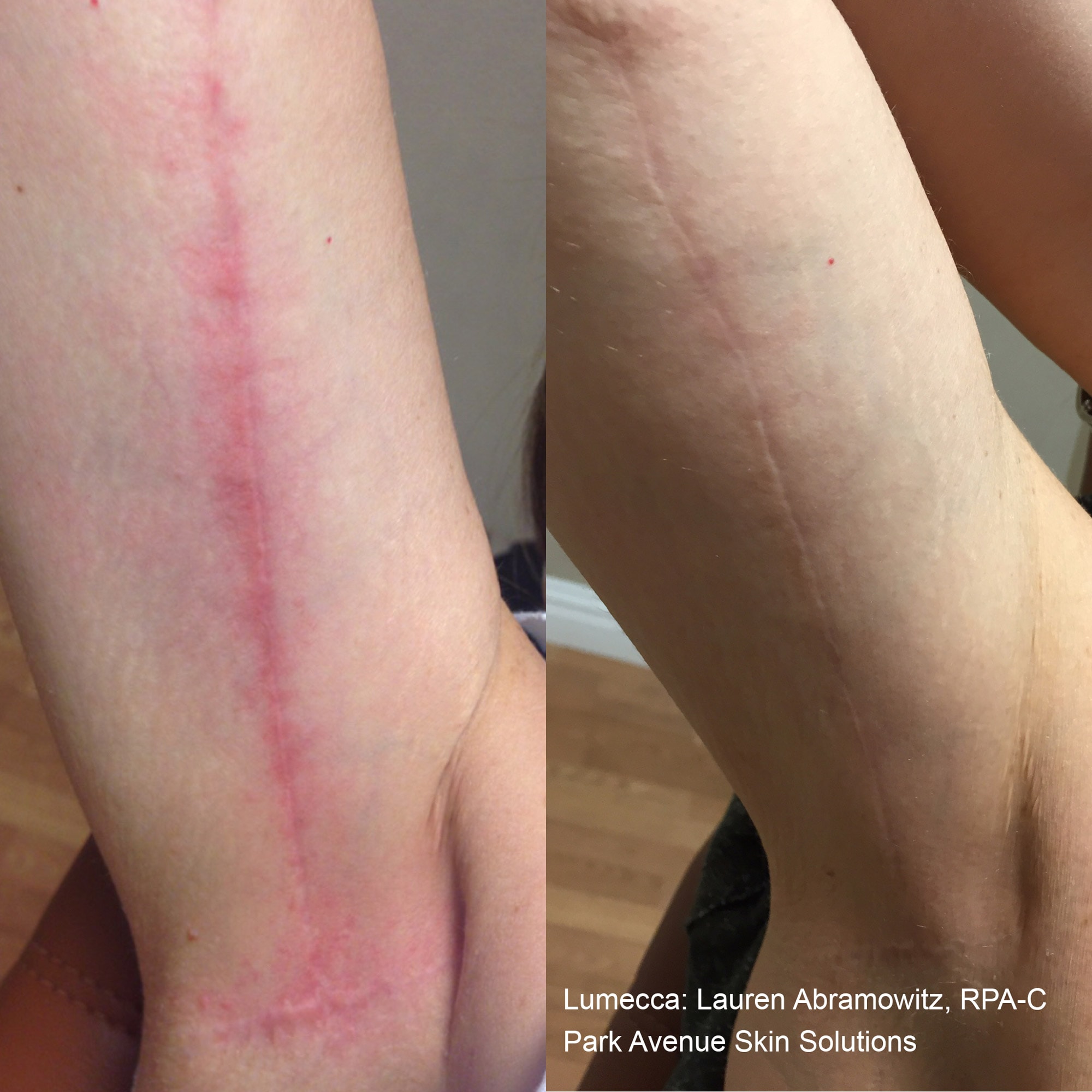 Before and After photos of Lumecca treatments reducing the angry redness on a surgical scar on a woman’s arm