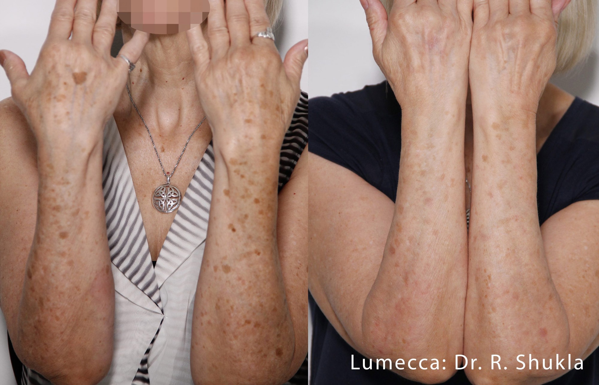 Before and After shots showing the results of Lumecca treatments eliminating sunspots and dark spots on the arms and hands