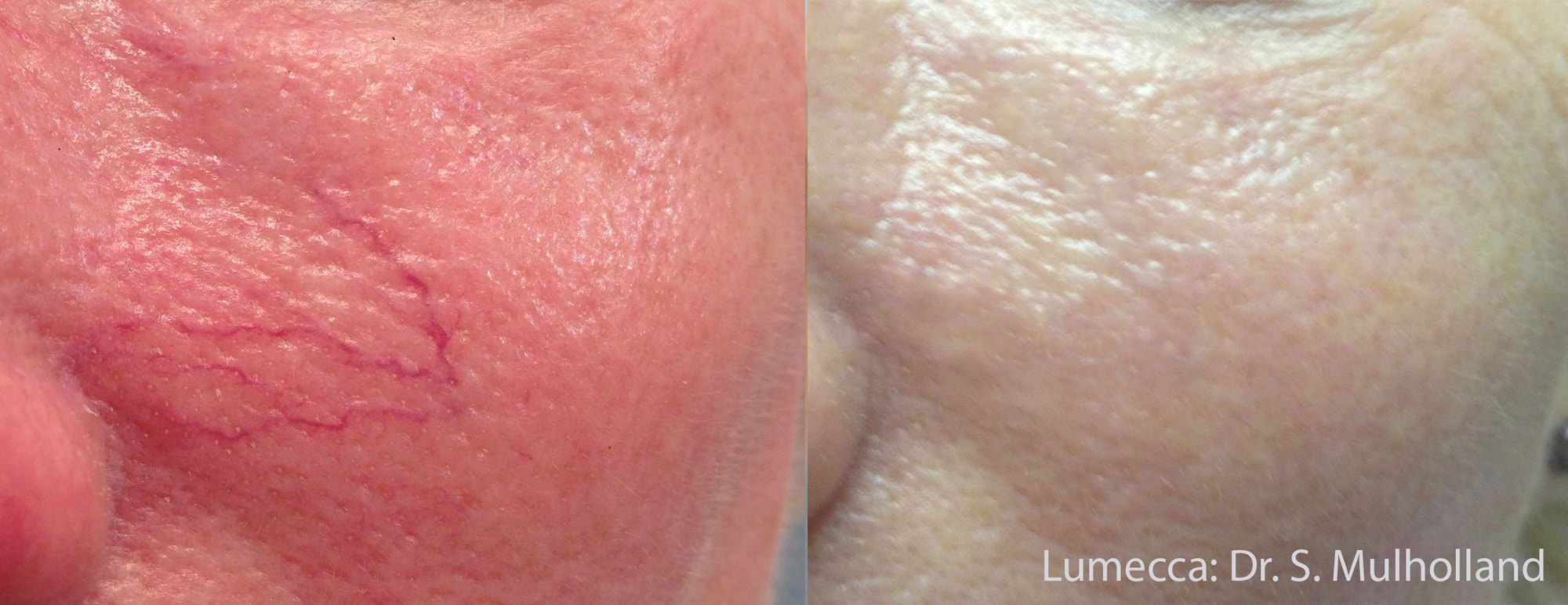 Before and After photos showing the results of Lumecca treatments eliminating prominent blood vessels on a man’s cheeks