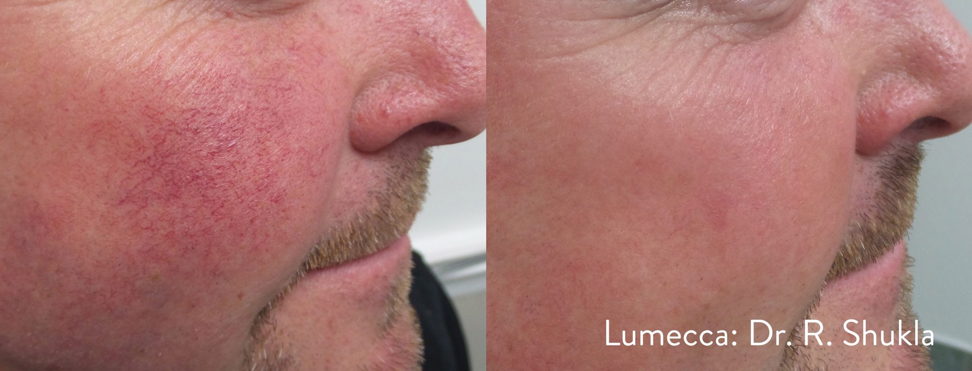 Before and After photos showing Lumecca treatments eliminating broken blood vessels on a man’s cheeks for a clear complexion