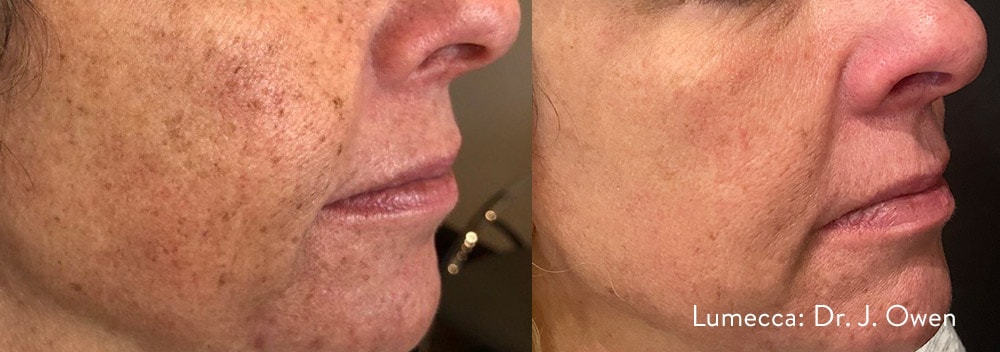 Before and After photos showing Lumecca eliminating freckles and dark pigmentation spots on a woman’s cheeks