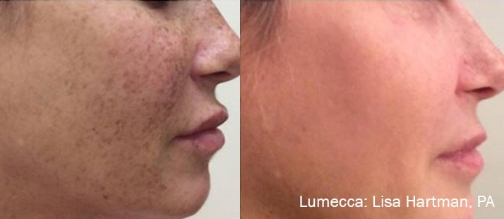 Before and After photos showing Lumecca eliminating freckles and dark spots on a woman’s cheeks for a clear complexion