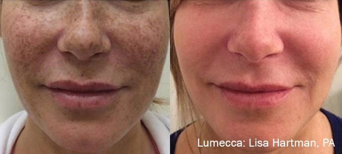 Before and After photos showing Lumecca treatments eliminating freckles and dark spots on a woman’s face