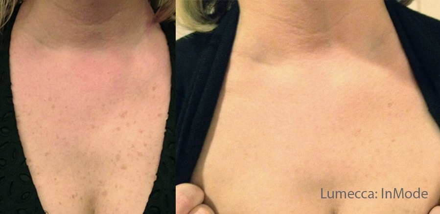 Before and After photos showing Lumecca treatments reducing dark spots and pigmentation on a woman’s decolletage