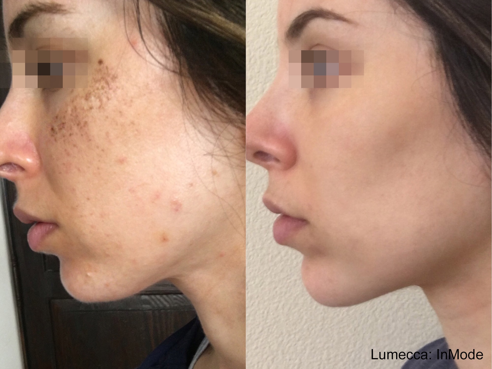 Before and After photos of Lumecca treatments improving skin texture and eliminating dark spots and acne on a woman’s cheeks