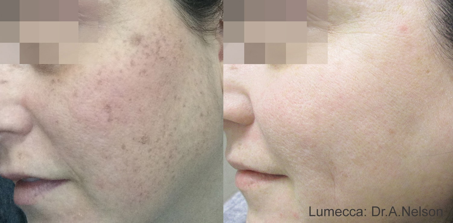 Before and After photos of Lumecca treatments improving texture and eliminating freckles and dark spots on a woman’s cheeks