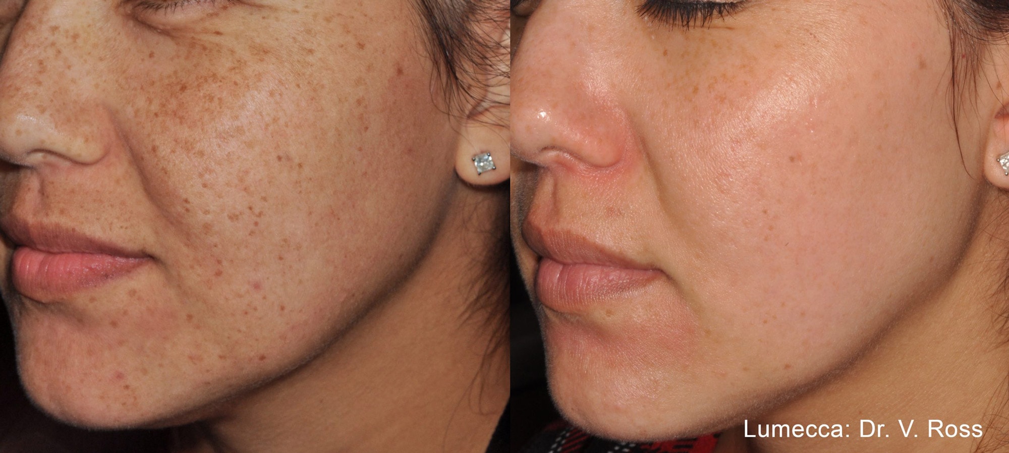 Before and After photos showing Lumecca treatments improving texture and reducing freckles and pigmentation on a woman’s face
