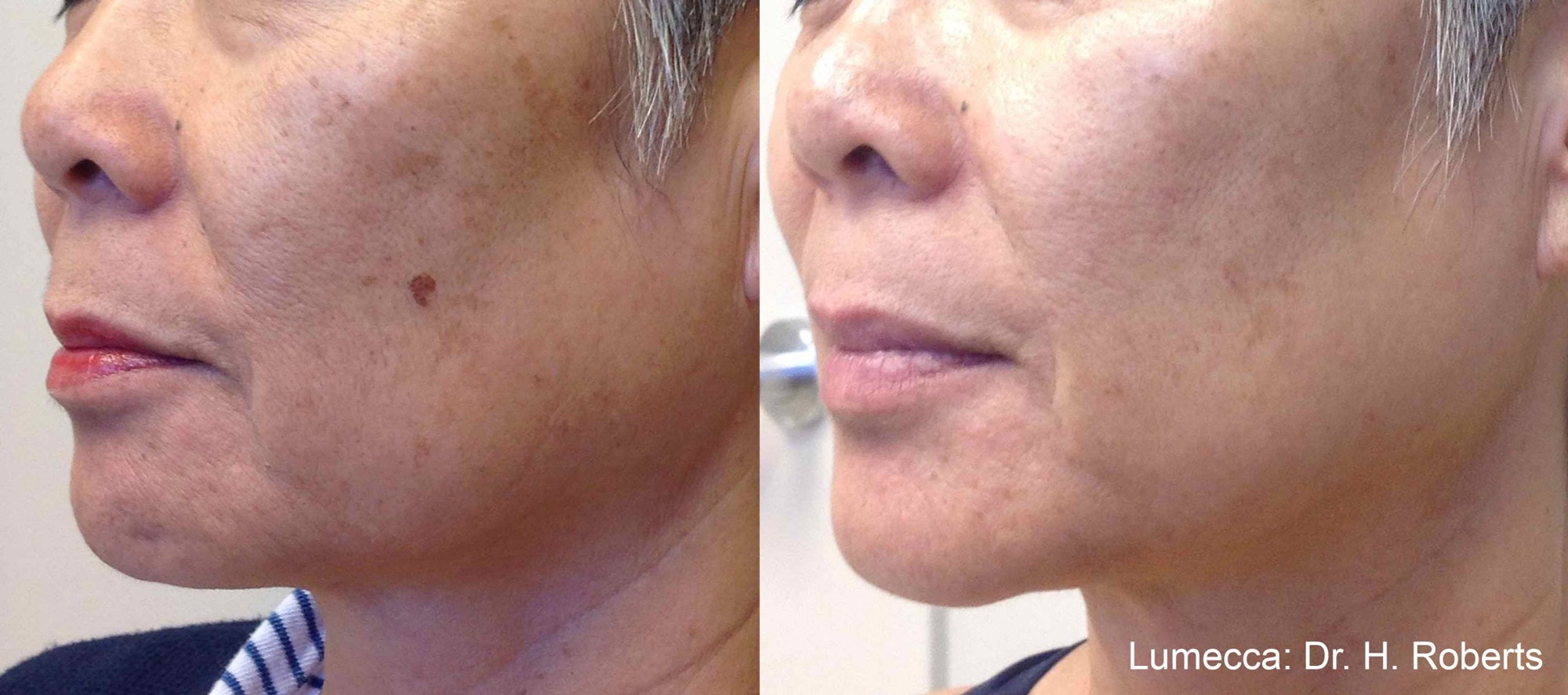 Before and After photos showing Lumecca treatments improving texture and reducing pigmentation spots on a woman’s cheeks
