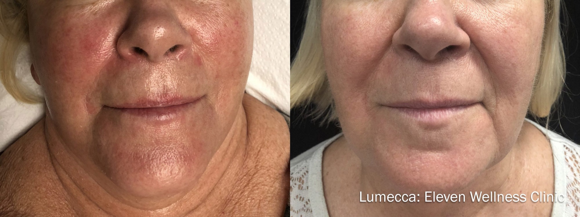 Before and After photos showing Lumecca treatments improving skin texture and removing rosacea on a woman’s face