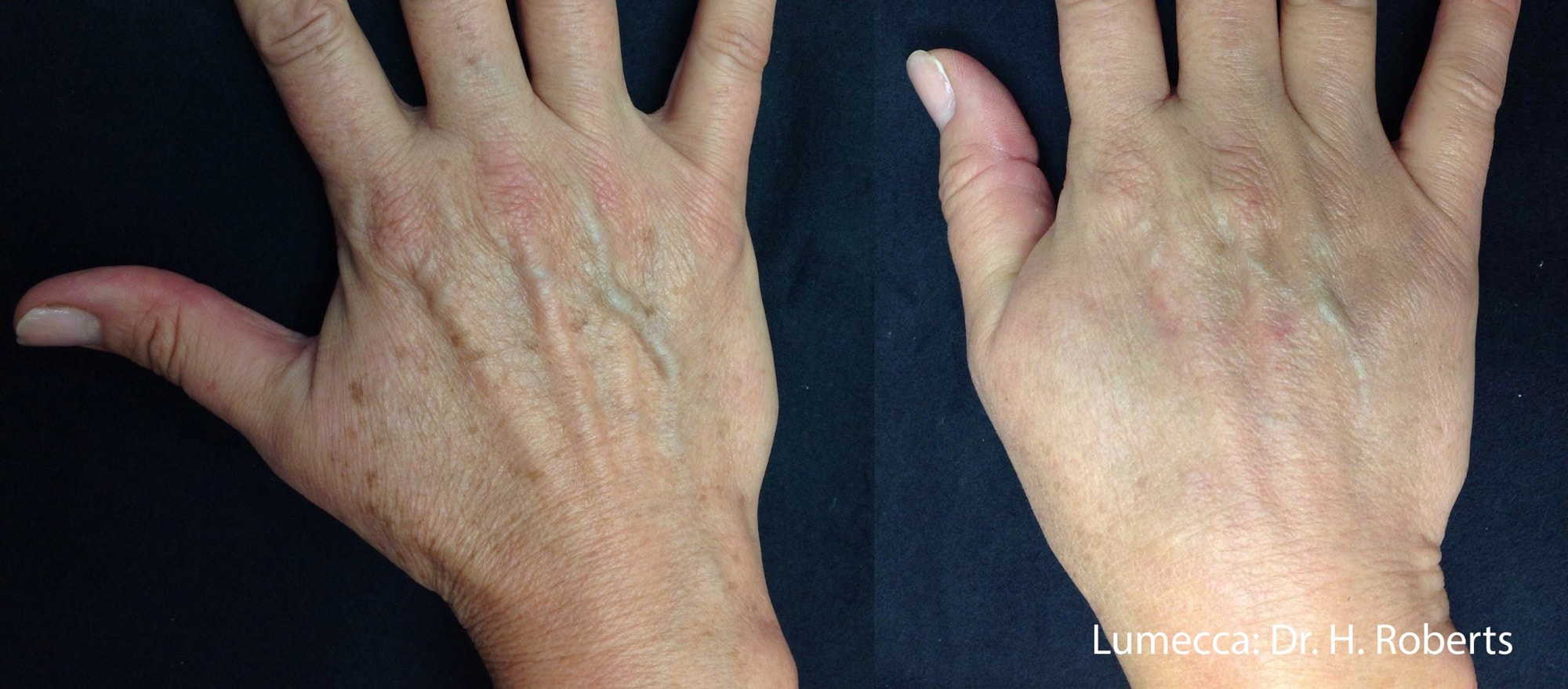 Before and After photos showing Lumecca treatments eliminating dark spots and pigmentation on a woman’s hands