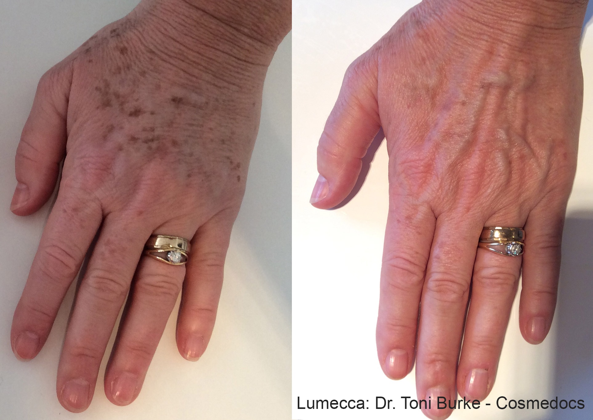 Before and After photos showing the results of Lumecca treatments for the elimination of sunspots and age spots on the hands