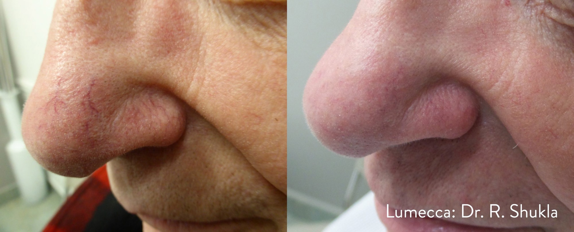 Before and After photos showing the results of Lumecca treatments eliminating broken blood vessels on a man’s nose