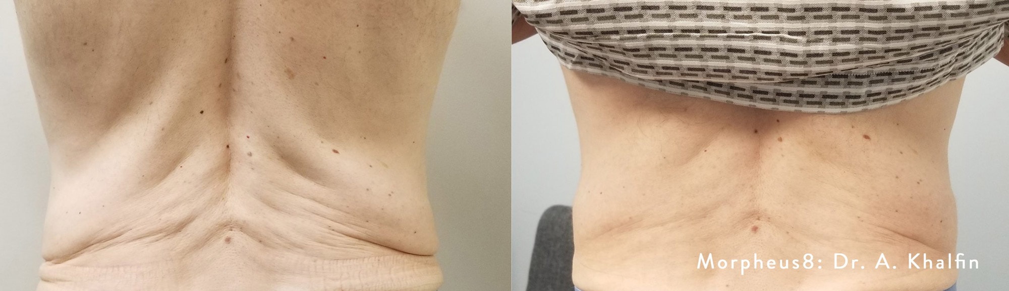 Before and After photos of Morpheus8 tightening loose skin and reducing deep wrinkles on a woman’s back
