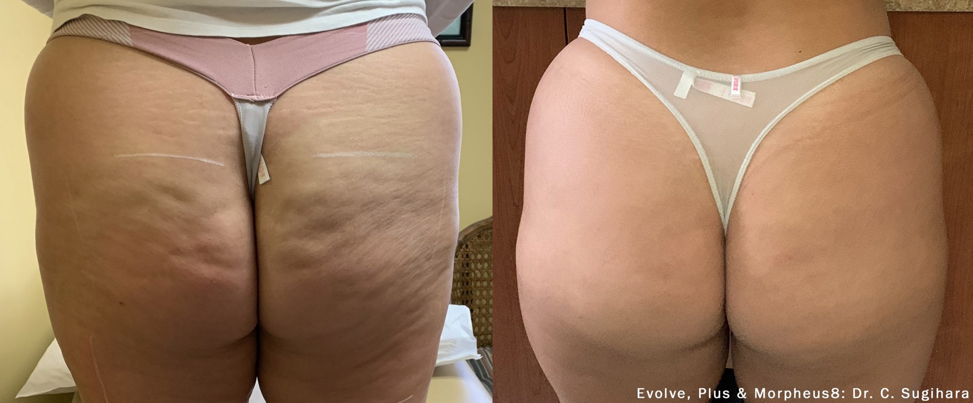 Before and After photos of Dr. Sugihara’s Morpheus8 and Forma Plus treatments reducing cellulite on a woman’s hips and butt