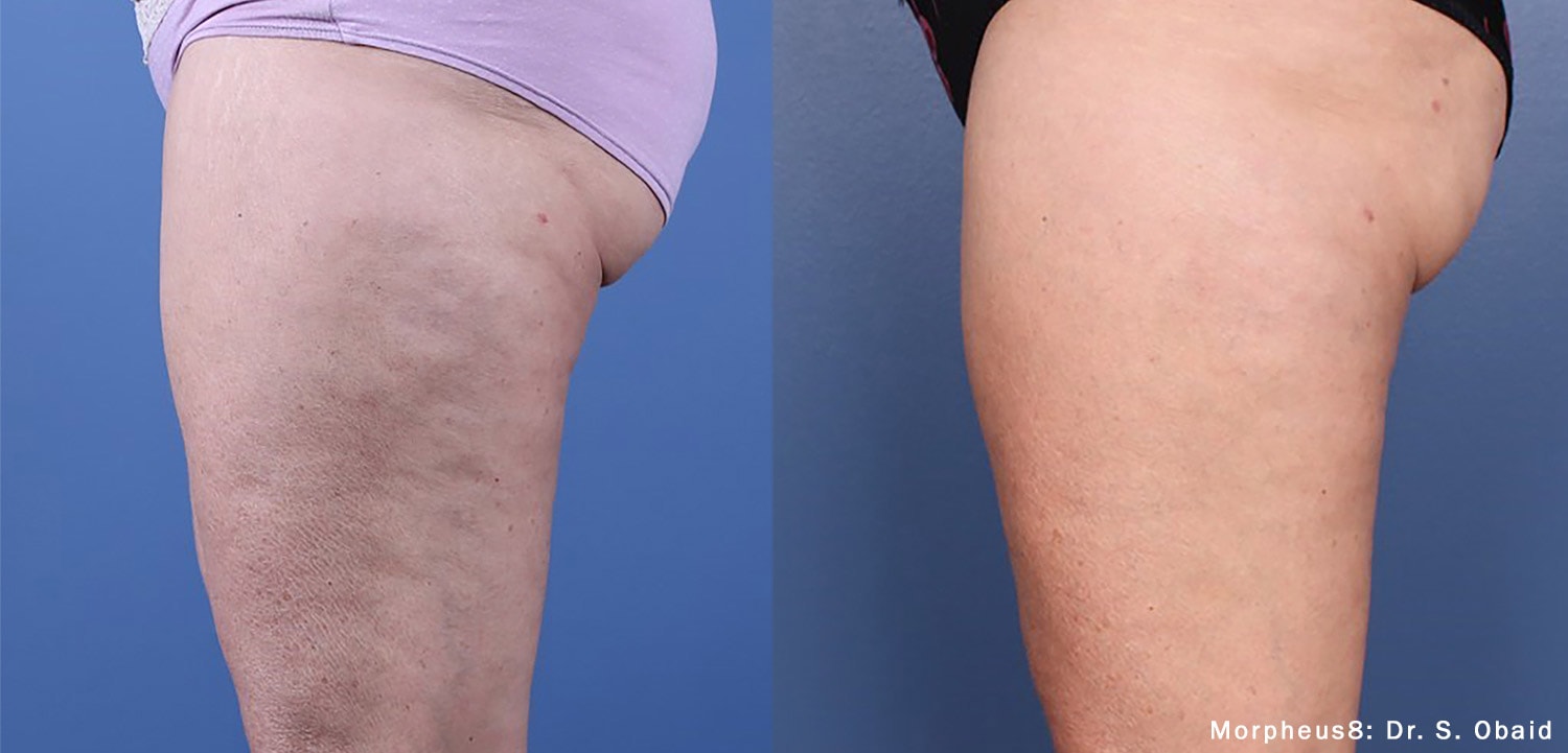 Before and After photos of Morpheus8 treatments reducing Cellulite and providing body contouring on the thighs