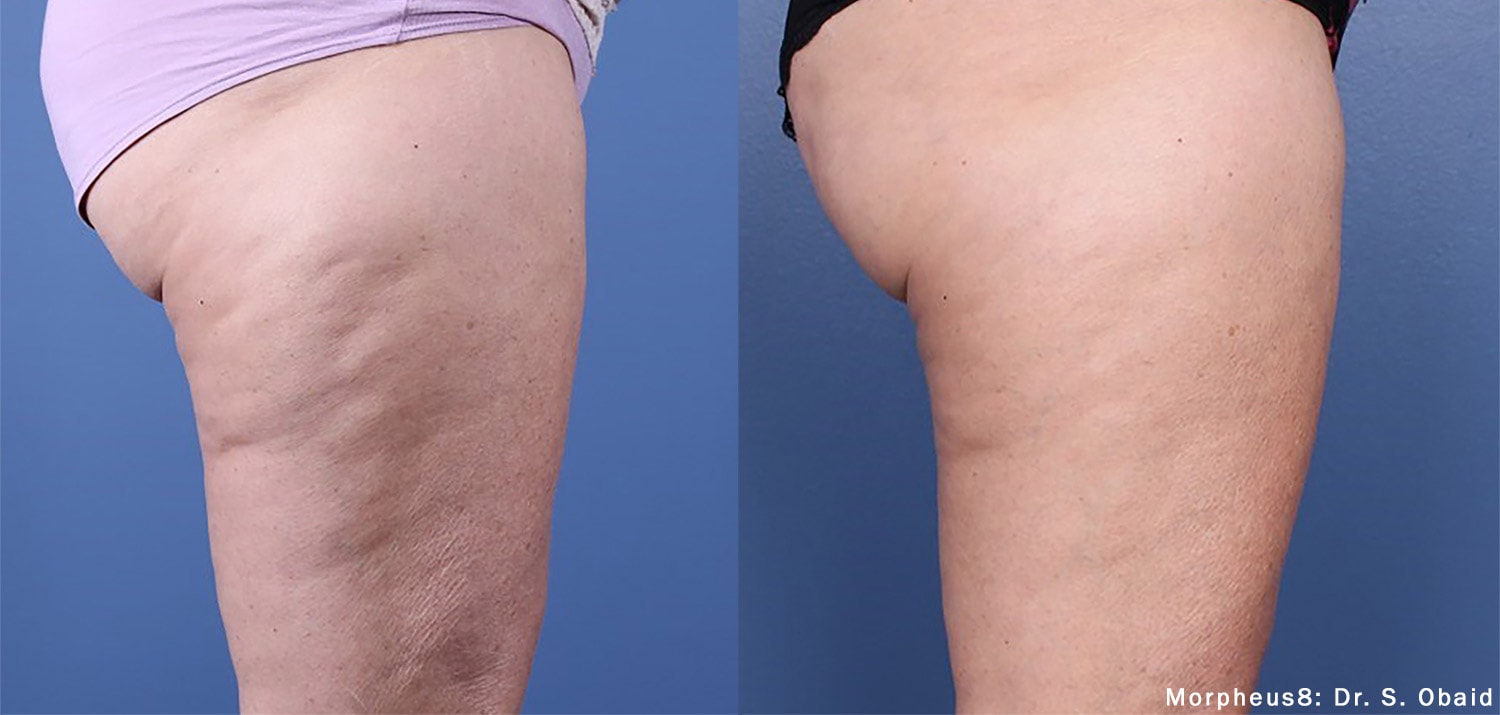 Before and After photos showing the results of Cellulite reducing treatments using Morpheus8 on the thighs