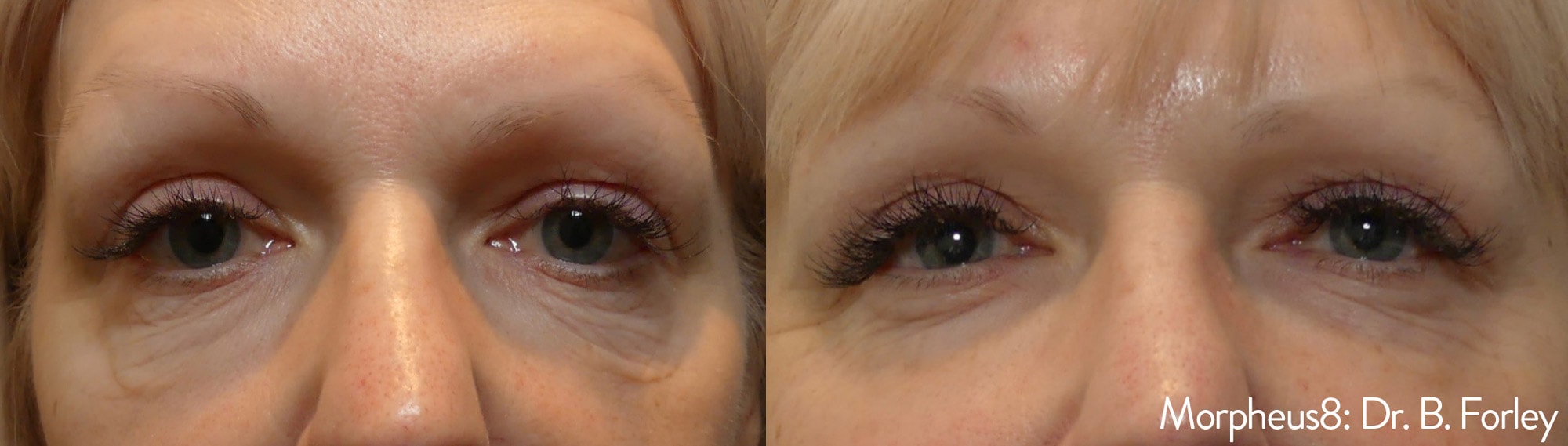 Before and After photos of Morpheus8 treatments eliminating bags and tightening loose skin around a woman’s eyes