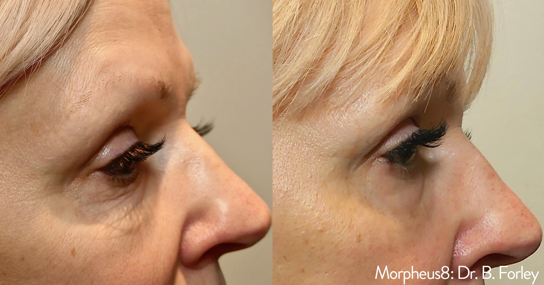 Before and After photos of Morpheus8 treatments tightening loose skin and reducing bags around a woman’s eyes