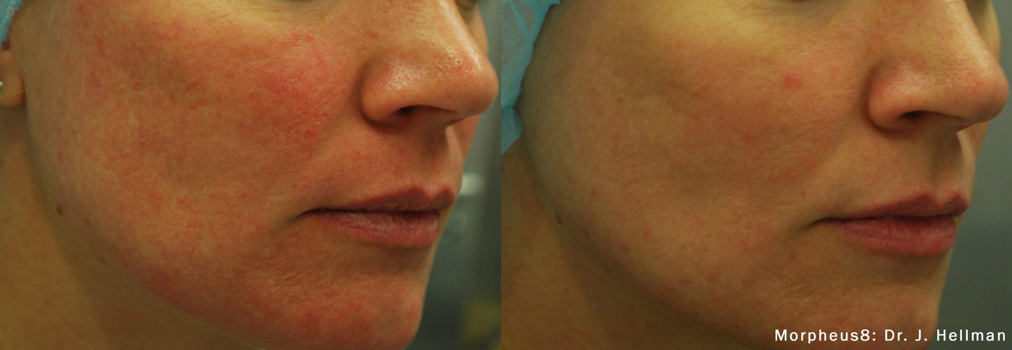 Before and After photos of Morpheus8 treatments reducing an acne outbreak and the improving texture on a woman’s cheek