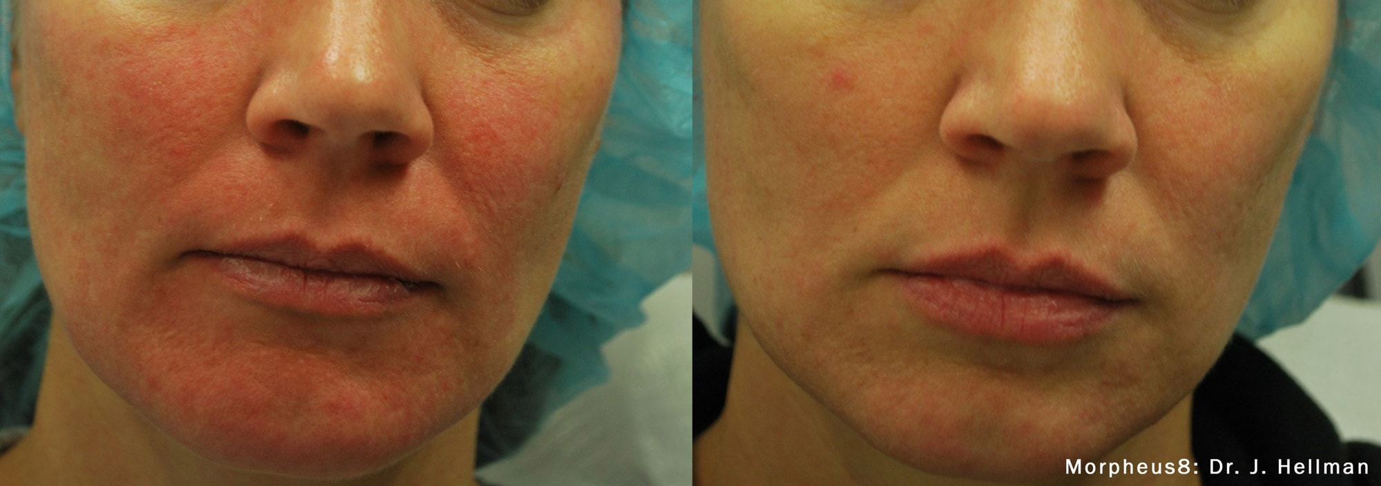 Before and After photos of Morpheus8 treatments reducing the angry redness of an acne outbreak on a woman’s face