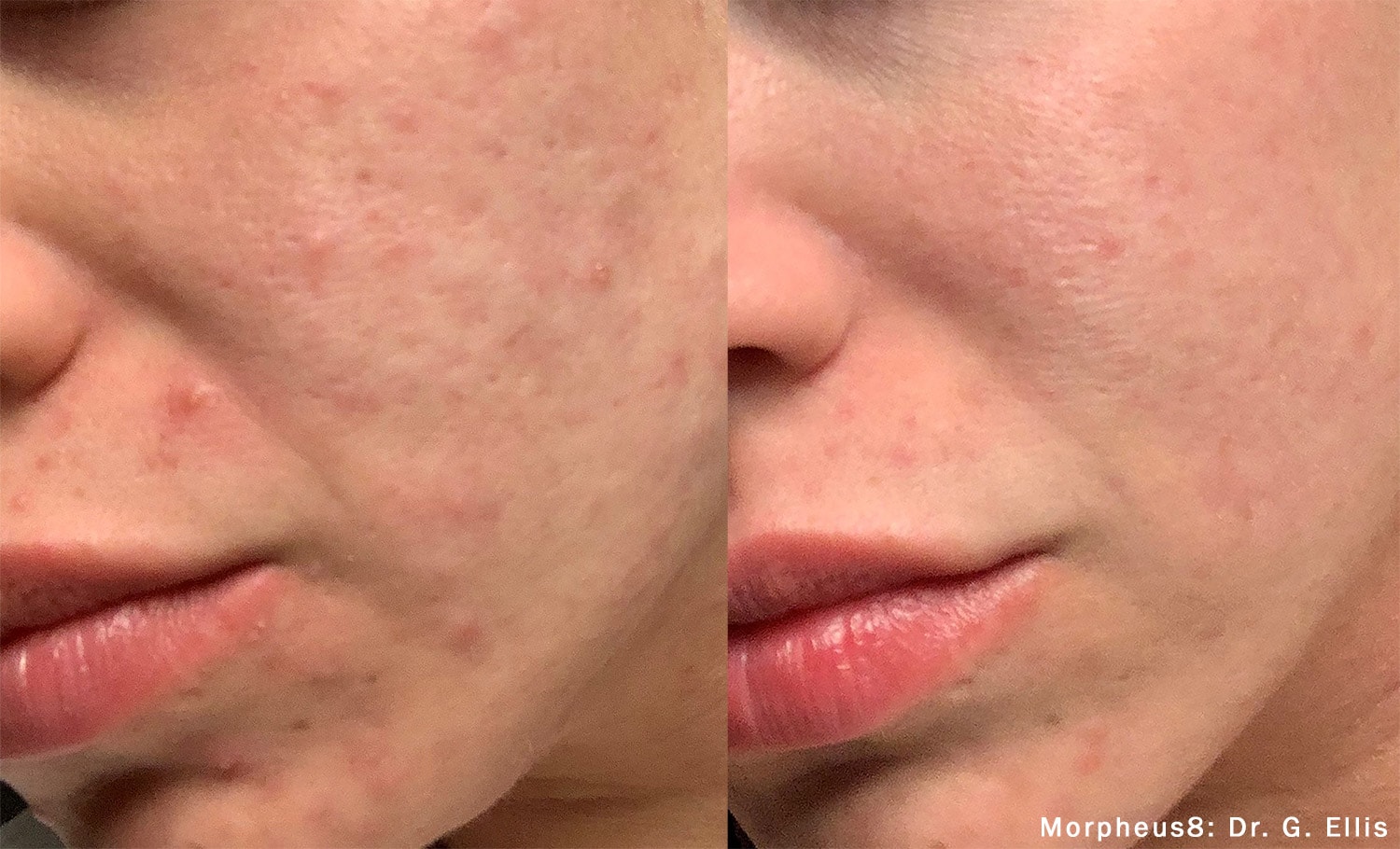 Before and After photos of Morpheus8 treatments reducing an acne outbreak on a woman’s cheek
