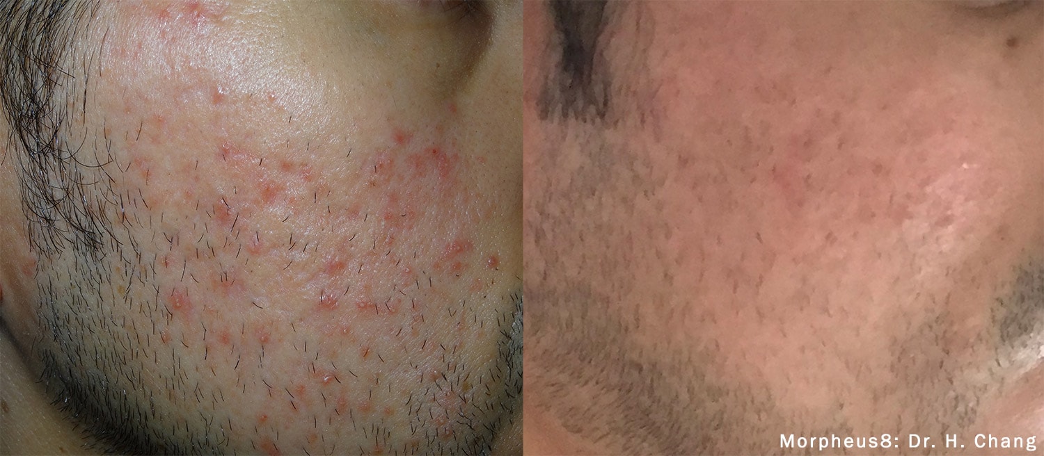 Before and After photos of Morpheus8 treatments reducing an acne outbreak and improving skin texture on a man’s cheek