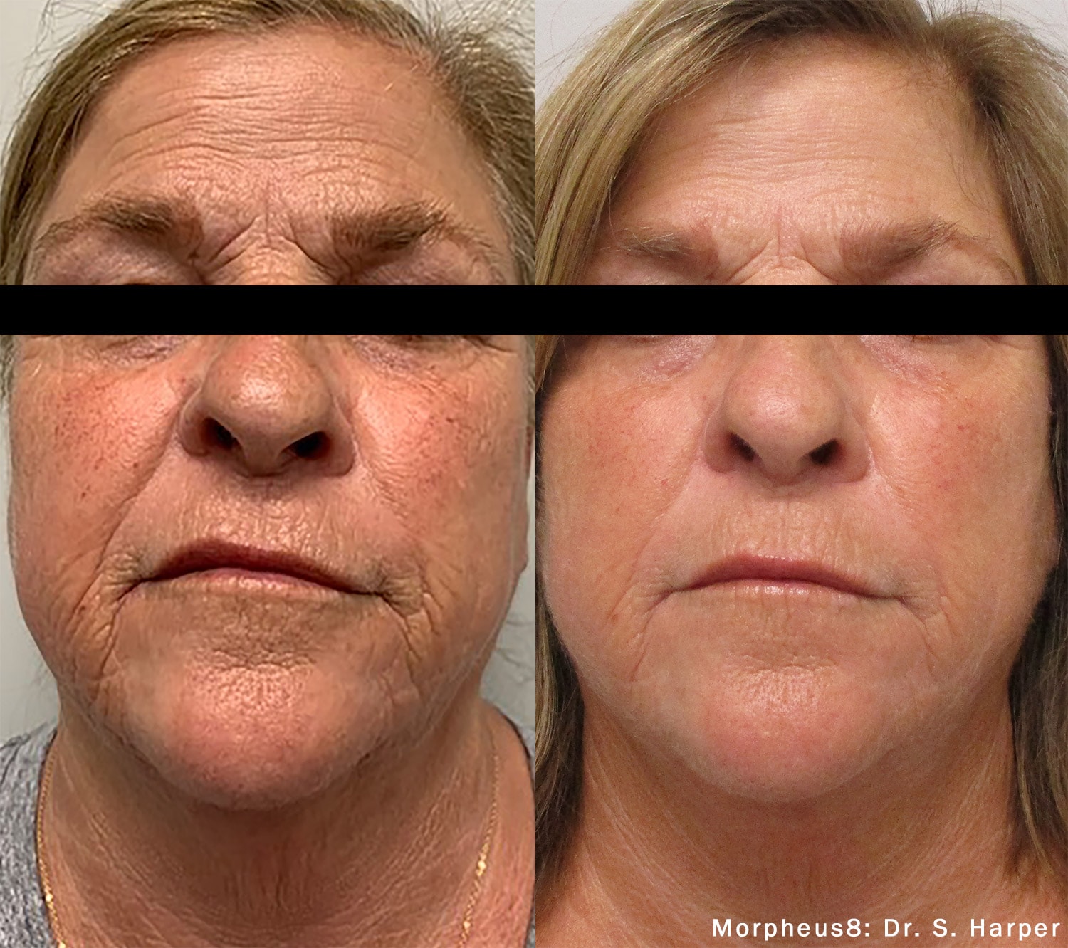 Before and After photos of Morpheus8 treatments reducing deep wrinkles from sun damage on a woman’s face and neck