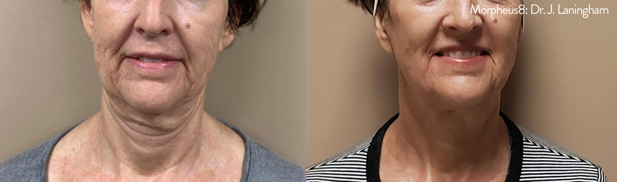 Before and After photos of Morpheus8 tightening loose skin and eliminating deep wrinkles around a woman’s neck and chin