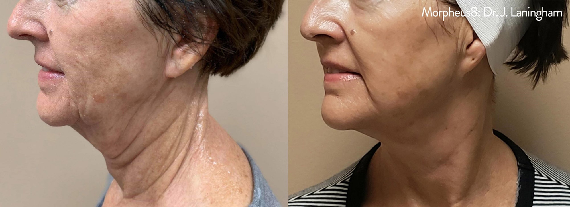 Before and After photos of Morpheus8 tightening loose skin, eliminating deep wrinkles and improving contour on a woman’s neck