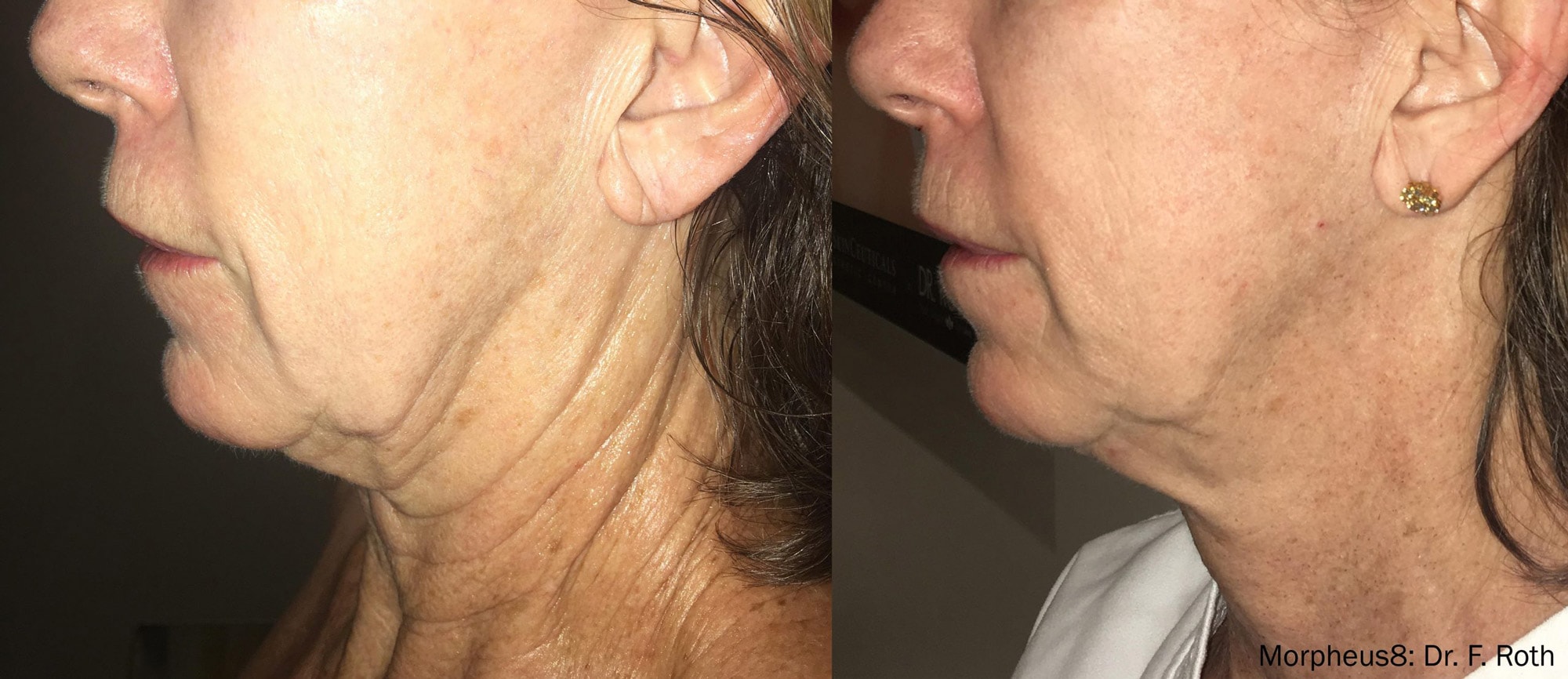 Before and After photos of Morpheus8 treatments tightening deep wrinkles and loose skin on a woman’s neck